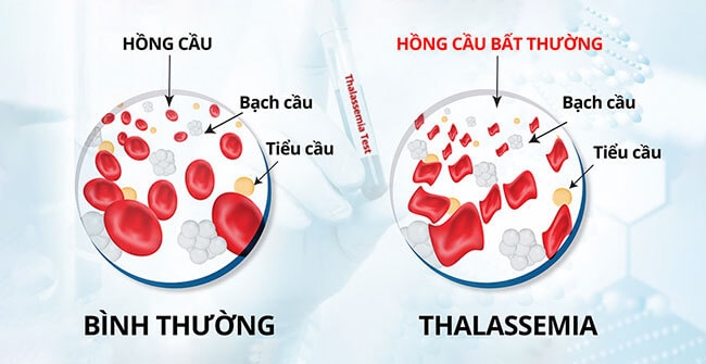 Tầm soát sớm bệnh tan máu bẩm sinh để nâng cao chất lượng dân số