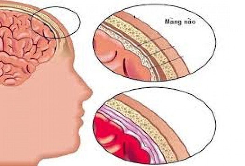 Dấu hiệu nhận biết khi bị viêm màng não