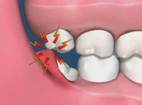 Mất mạng vì răng khôn, nếu xử lý không đúng