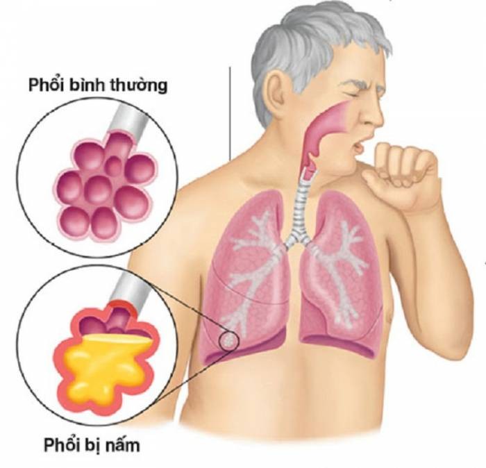 Nấm phổi do Aspergillus: Nhiều quốc gia không đủ nguồn lực để chẩn đoán và điều trị