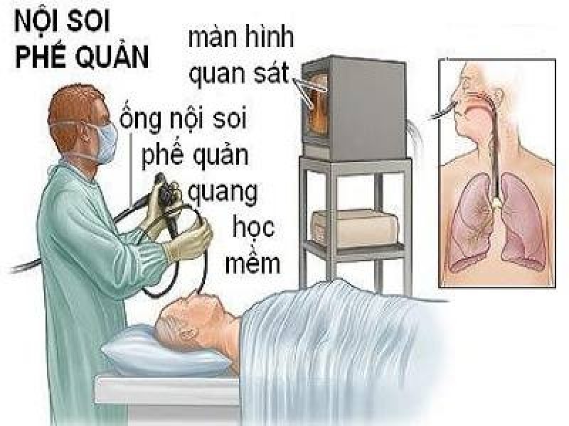 benh vien bach mai bao cao nguyen nhan tu vong cua benh nhan noi soi phe quan