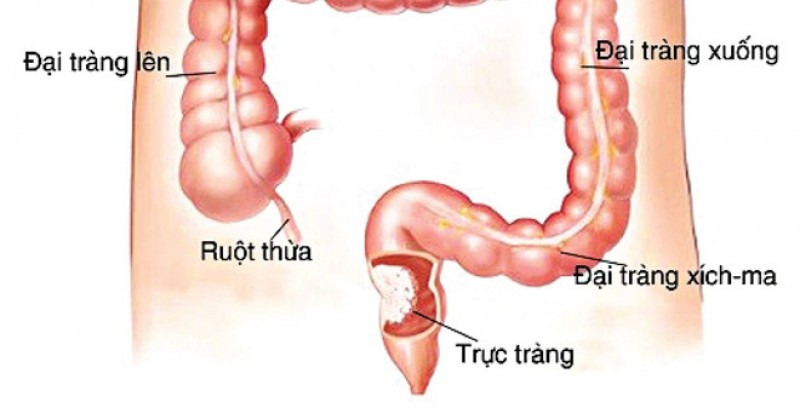 ha noi trien khai du an phat hien som ung thu truc trang